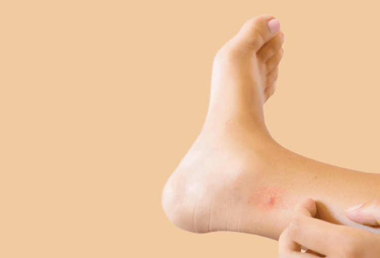 UK Insect Bites Bugs That Bite UK Hey Pharmacist