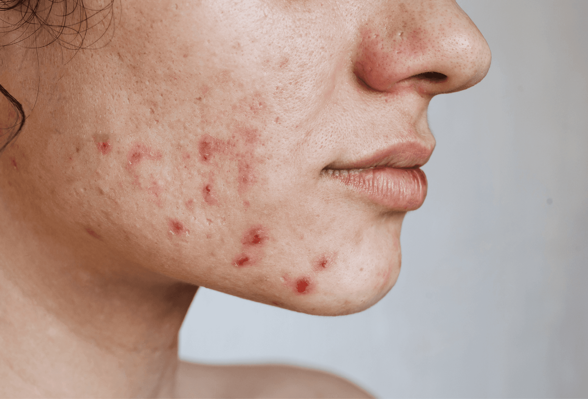 person showing acne on face