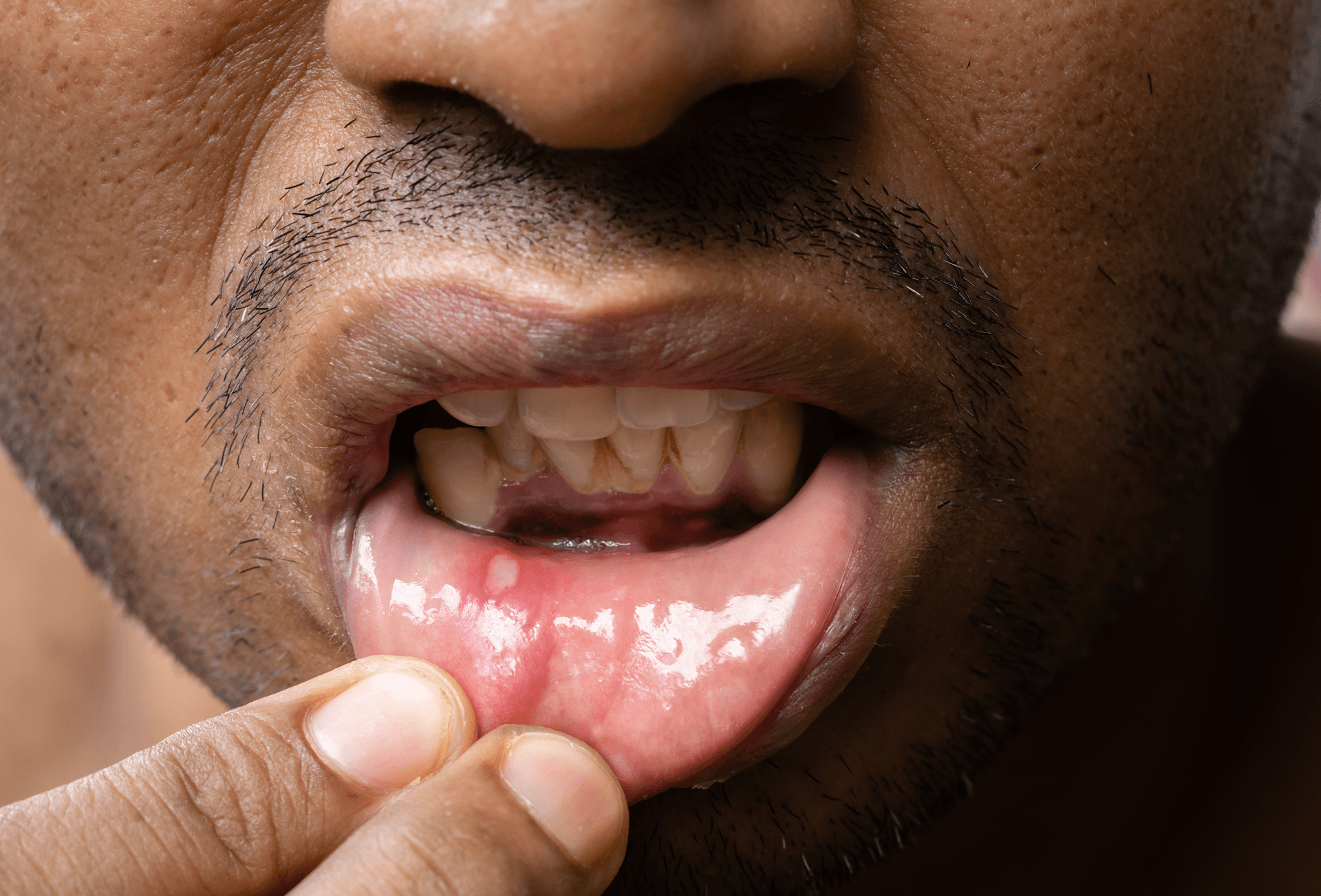 man holding lip down to show mouth ulcer
