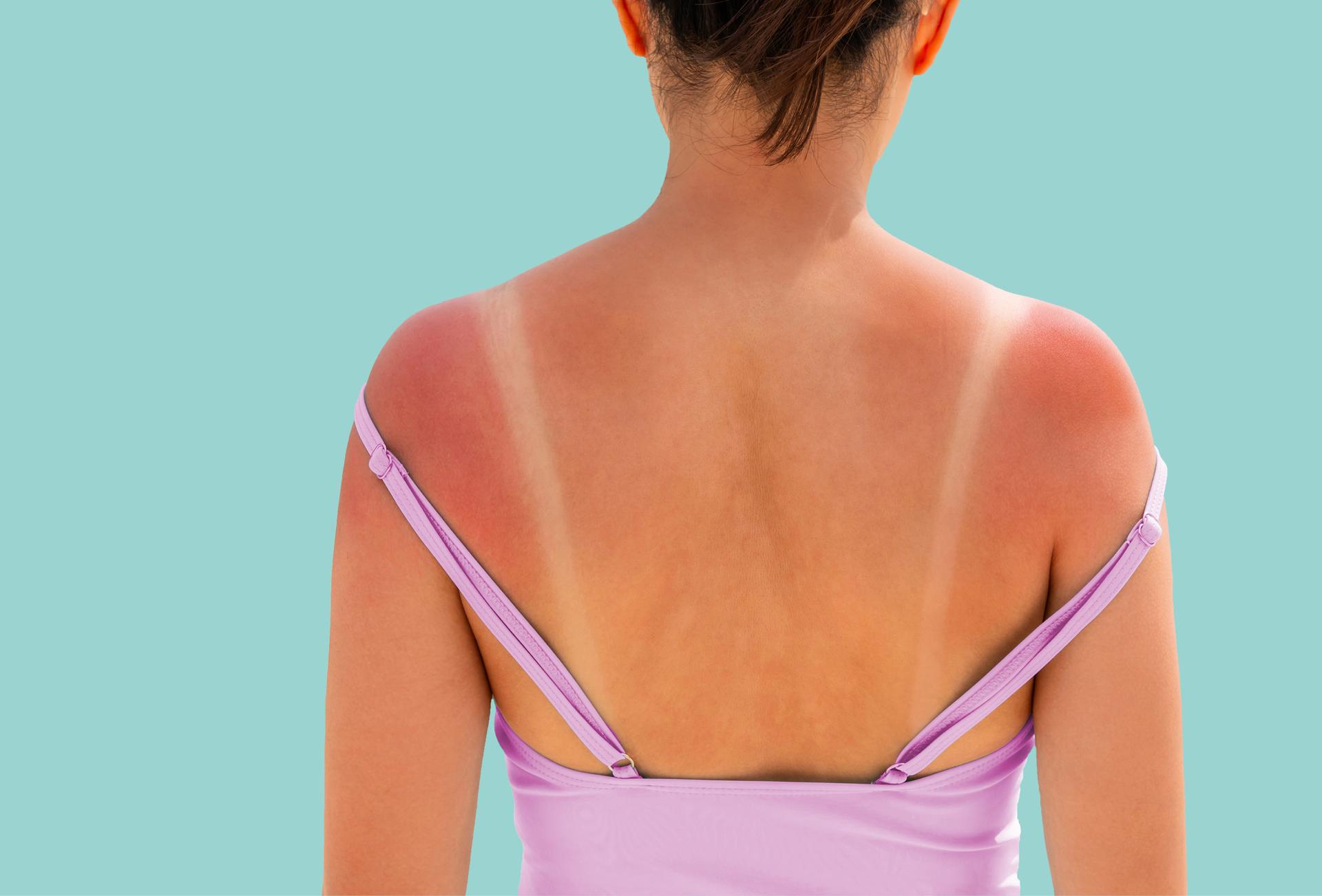 Woman with a sunburnt back